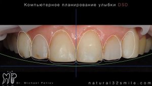Эстетическая и функциональная реабилитация с помощью 6 керамических реставраций виниры e max press