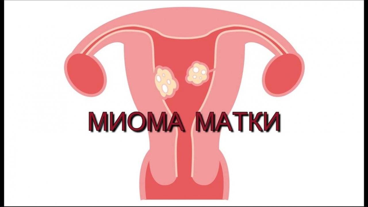 МИОМА МАТКИ