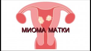 МИОМА МАТКИ