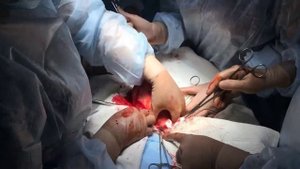 Надвлагалищная ампутация матки