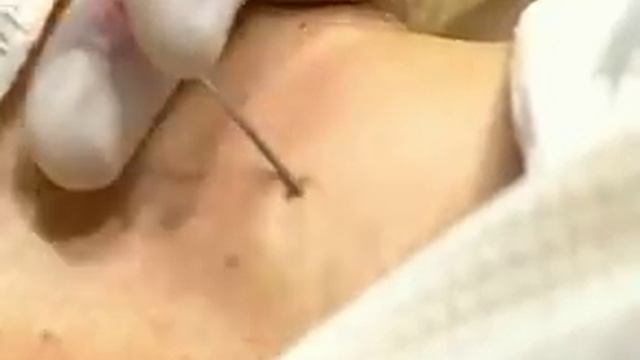 Катетеризация внутренней яремной вены смотреть онлайн