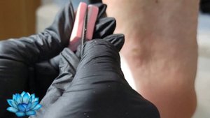 Стержневая мозоль или подошвенная бородавка. Что это? #2
