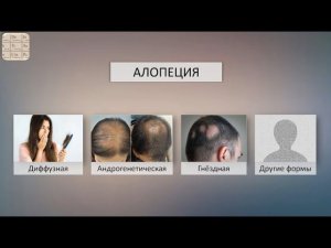 Важные отличия между разными формами алопеции