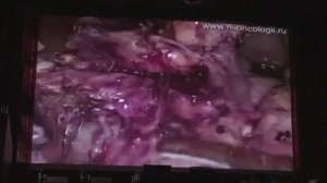 Лекция лапароскопия рака желудка