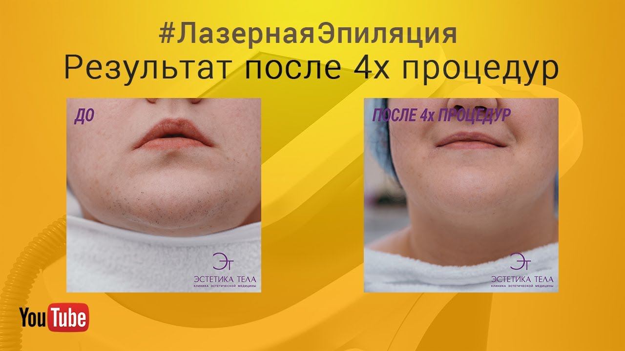 Лазерная эпиляция 5 эксперимент | Реальные отзывы | Результаты до и после