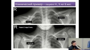 Доклад, переломы ключицы у детей, Москва 2020