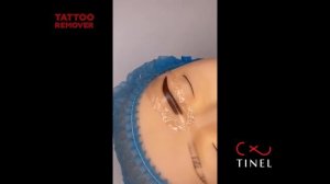 Ремувер TINEL удаление татуажа (часть 3)
