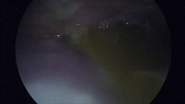 асцит перитонит. канцероматоз смотреть онлайн