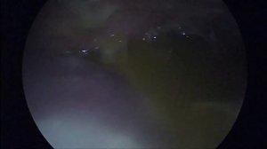 асцит перитонит.  канцероматоз