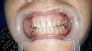 Художественная реставрация зубов