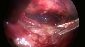 TEP  герниопластика