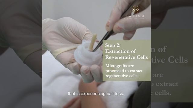 Regenera Activa | Hair Loss Treatment in Singapore смотреть онлайн