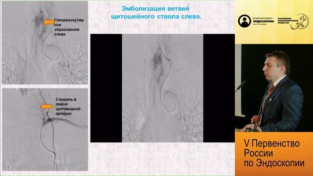 Эндоскопическое удаление рецидивной кавернозной гемангиомы шейного отдела пищевода