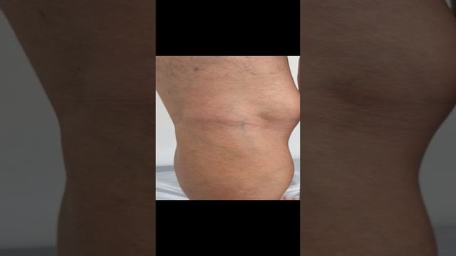 Сосудистая сетка на ногах. Варикоза нет. Флеболог Москва. Флеболог. Сосудистый хирург. Лечение вен смотреть онлайн