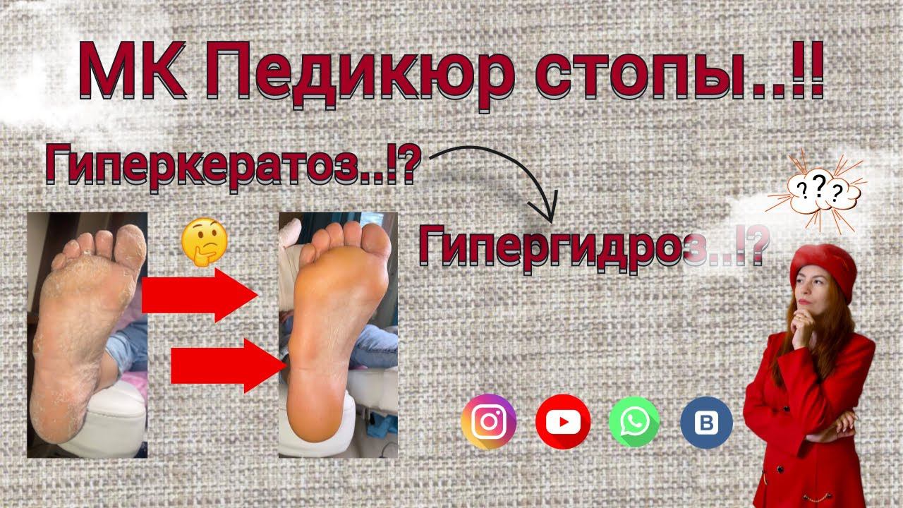 МК Педикюр стопы! Гиперкератоз? Гипергидроз?