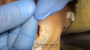 Керамические виниры EMAX/ Все этапы. Цвет блич 4