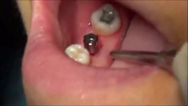 Одноэтапная безлоскутная установка имплантата AnyOne в области зуба 46 смотреть онлайн