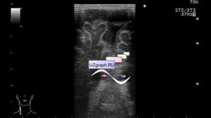 УЗИ головного мозга/нейросонография - Внутричерепные кровоизлияния, врожденный порок сердца (ВПС)