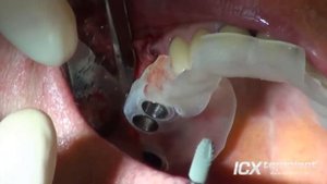 Внутренний синус-лифтинг и имплантация 3-на-ICX в верхнюю челюсть