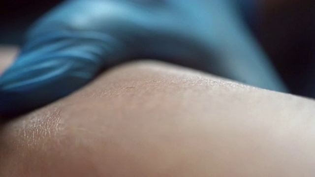Электроэпиляция
