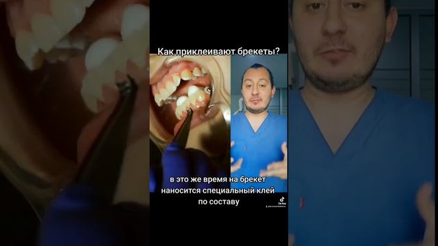 Как клеят брекеты?🤔🦷 #стоматолог #стоматология #брекети #брекеты #ортодонт #ортодонтия #прикус #бак