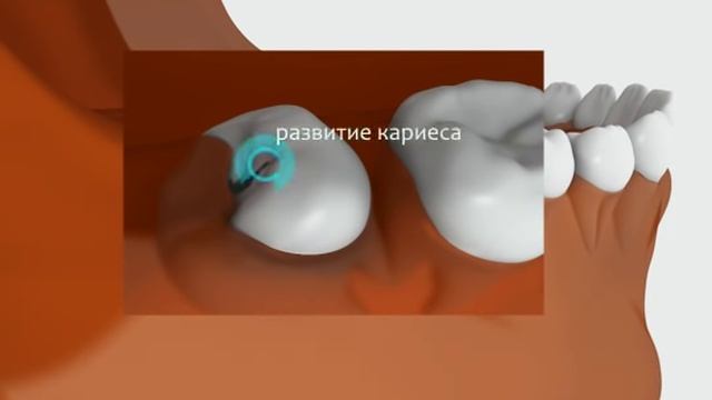 Прорезывание зубов. Прорезывание зуба мудрости смотреть онлайн