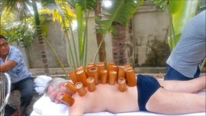 Лечение банками на Хайнане \\ Sanya, Hainan China
