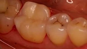 Лазерная стоматология