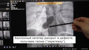 Установка окклюдера при дефекте межпредсердной перегородки (ДМПП).