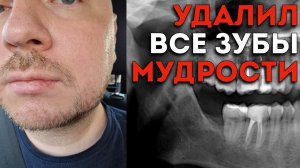 Удалил все "зубы мудрости"