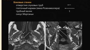 КТ диагностика рака шеи, часть 4, носоглотка