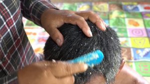 Itchy Dry Scalp Dandruff Satisfying And Picking A Lot Maggot Worm On Old Man Head #1009