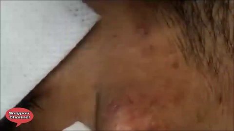 Part 02 how to removal blackhead and how to get rid of blackhead on face