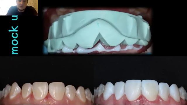 Керамические виниры. Бесплатный вебинар Артура Лукьяненко смотреть онлайн