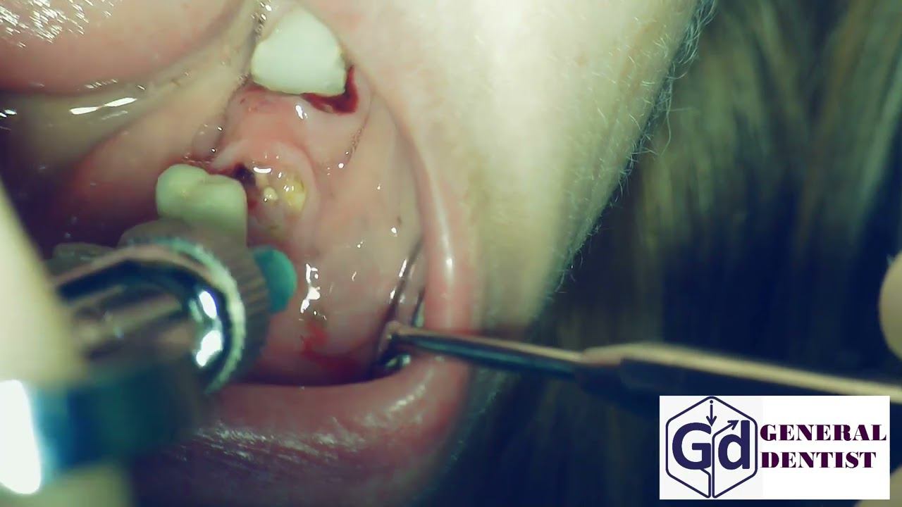 Infiltration anesthesia fo extraction 35.