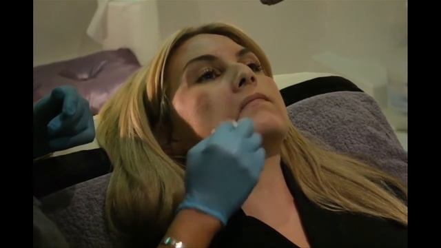 Radiesse Injection Technique - Traceybell смотреть онлайн