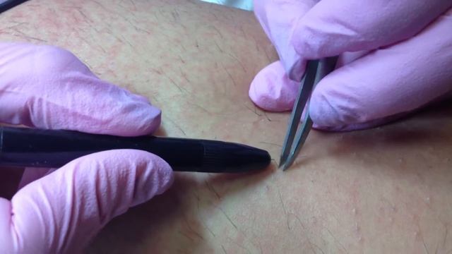 Эпиляция смотреть онлайн