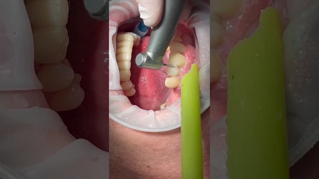 1-й этап обработки зубов под коронки: СЕПАРАЦИЯ. #цифроваястоматология #3dstomatolog #виниры