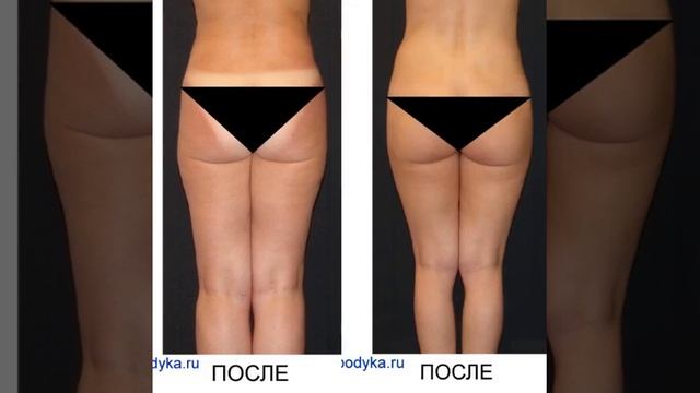 КОРРЕКЦИЯ ФИГУРЫ МАССАЖЕМ. ЦЕЛЛЮЛИТ НА БЕДРАХ И ЯГОДИЦАХ.
