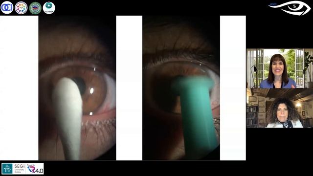 Therapeutic Use of #ScleralLenses. Sclerals are Best! | OOLS | Dr. Daddi Fadel & Dr. Melissa Barnet смотреть онлайн