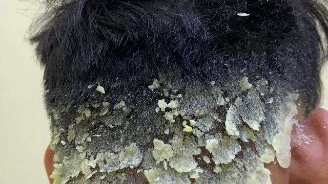 Царапины от перхоти большими хлопьями ( Big Flakes ) #645 смотреть онлайн