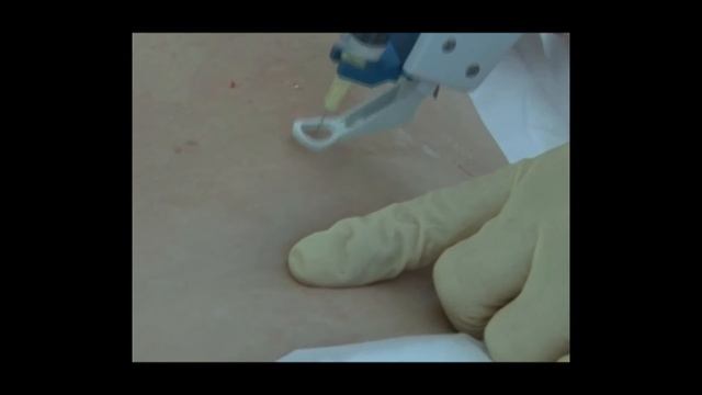 Коррекция жировых отложений мезоинжектором Pistor 4