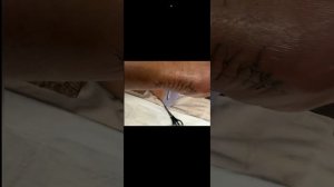Закрытый перелом наружной лодыжки со смещением.