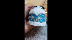 Съемные протезы