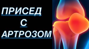 ПРИСЕДАНИЯ С АРТРОЗОМ КОЛЕННОГО СУСТАВА 3 СТЕПЕНИ