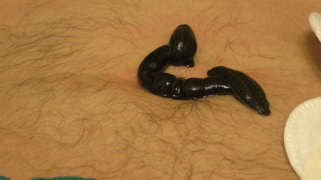 Пиявки, постановка на пупок смотреть онлайн