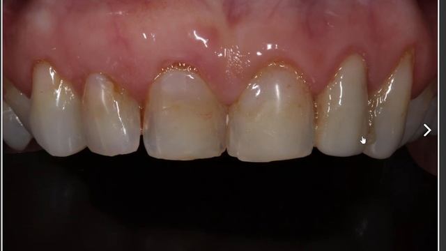 Gum Recession Treatment: Step By Step смотреть онлайн