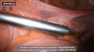 Лапароскопия  Функциональная оценка маточных труб  Тубэктомия  Эндометриодная гетиротопия