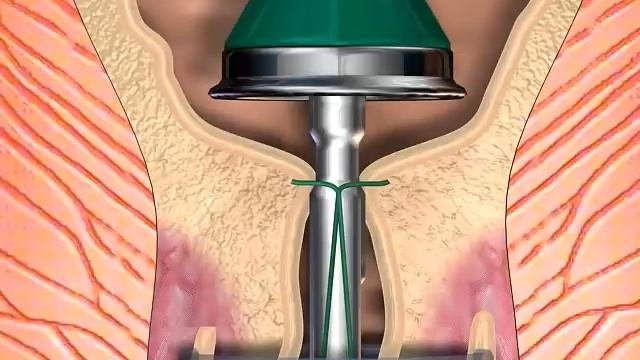 PPH Procedure Animation | Stapled Hemorrhoid Surgery