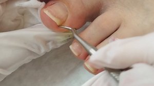 Подногтевые мозоли. Ковыряю и обрезаю